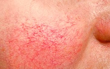 Arañitas vasculares faciales